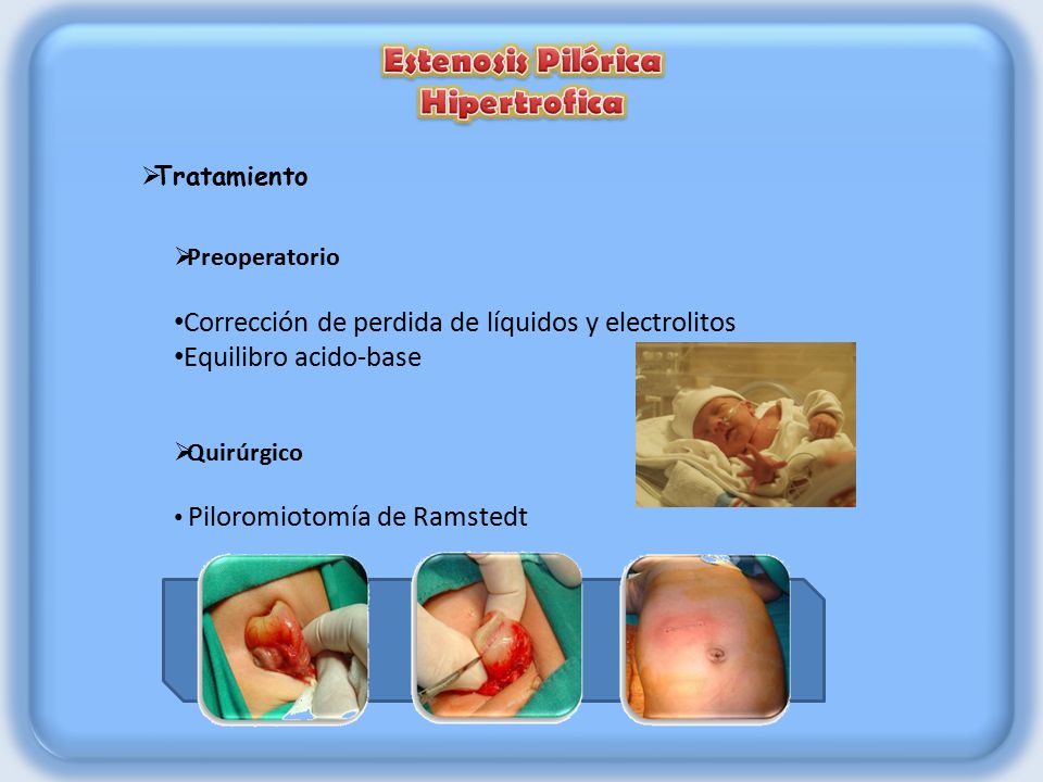 Estenosis pilorica causas sintomas y tratamiento